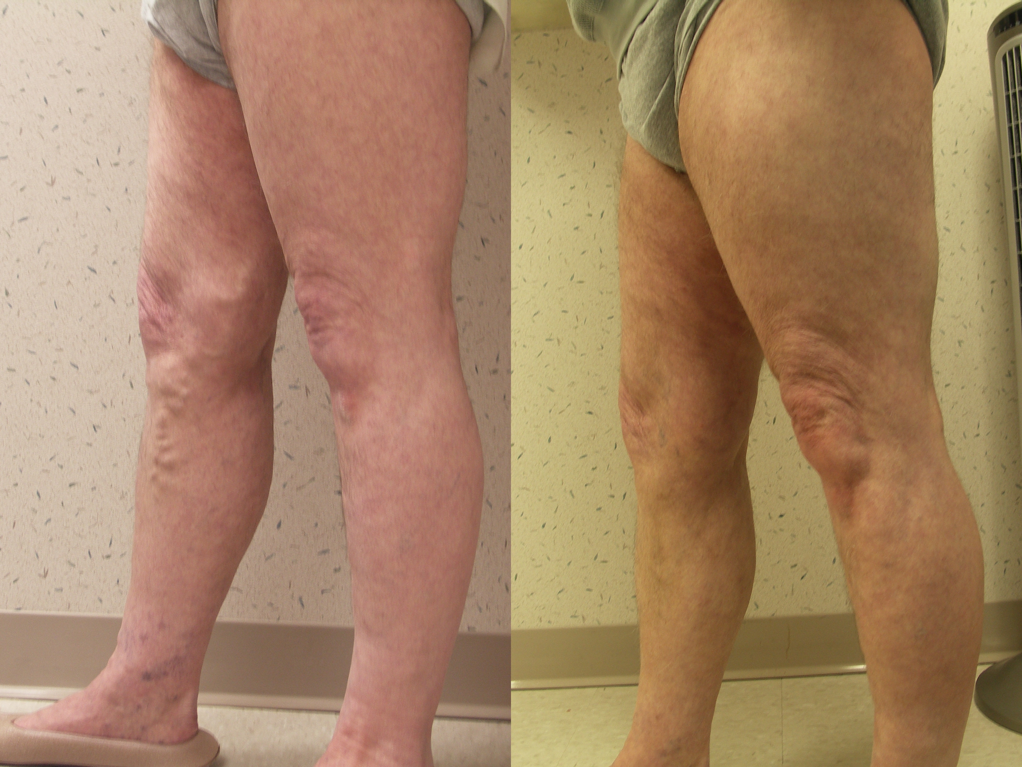 Patient before and after vein treatment showing improved leg appearance and reduced vein visibility