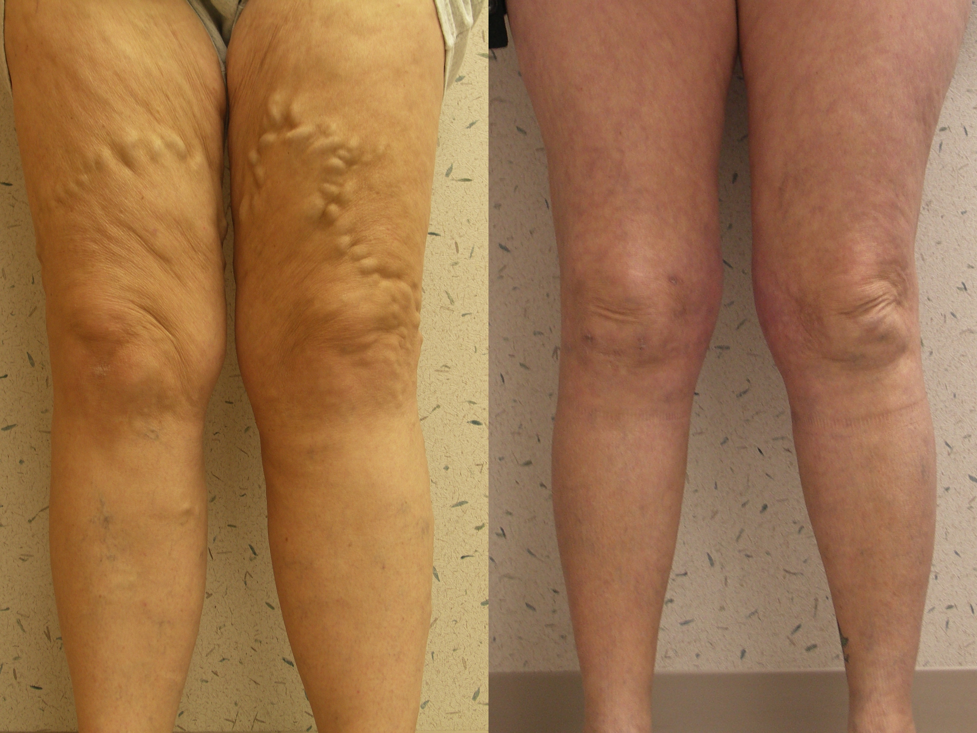 Patient before and after vein treatment showing healed and rejuvenated leg skin