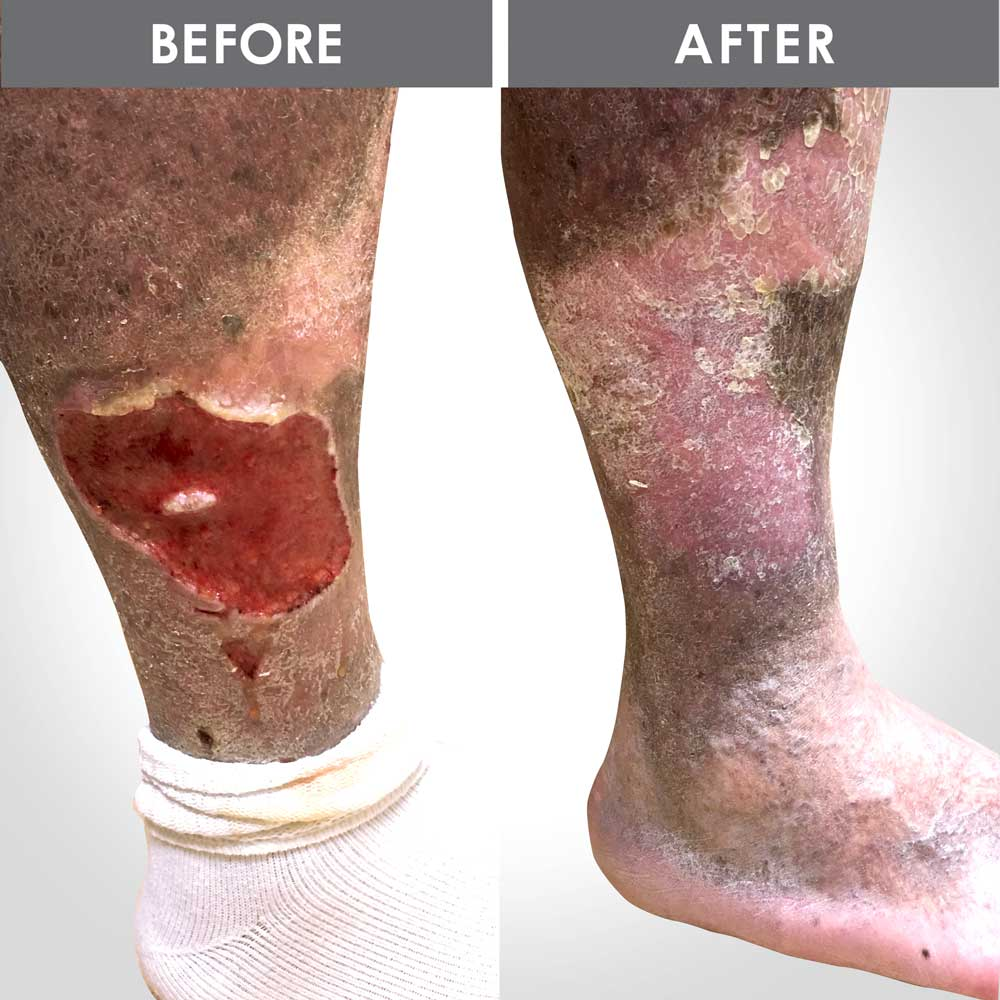 Venous ulcer before and after treatment — showing the dramatic healing results achieved through endovenous ablation at America's Vein Doctors