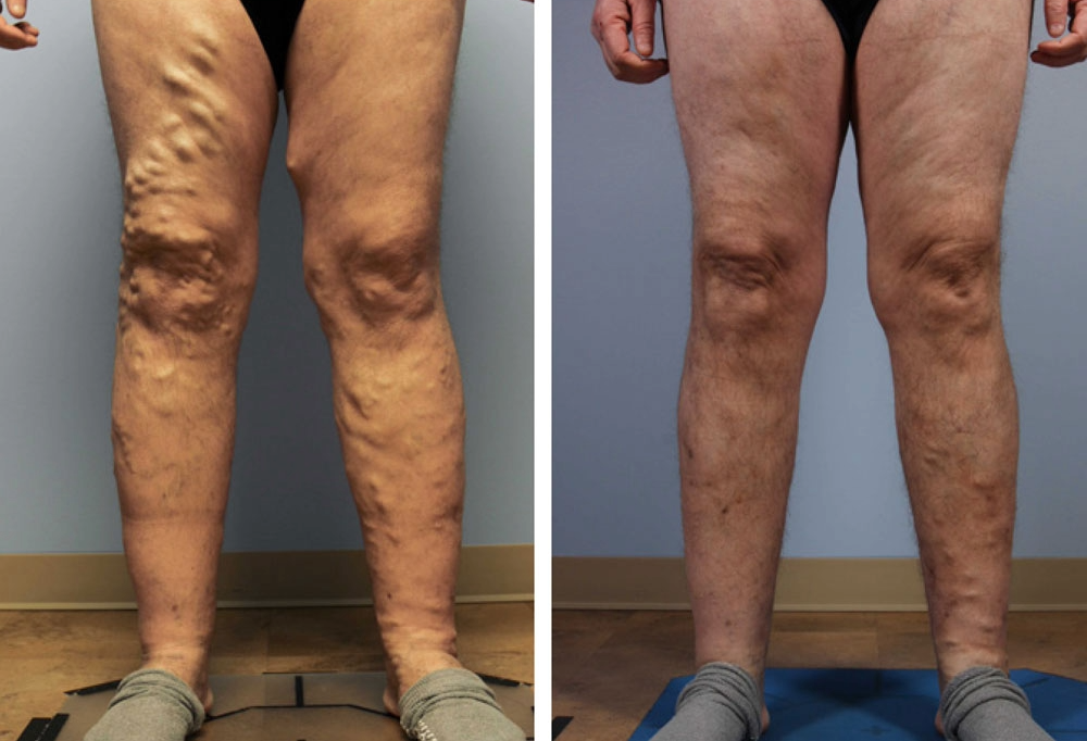 Patient before and after vein treatment showing significant improvement in leg appearance