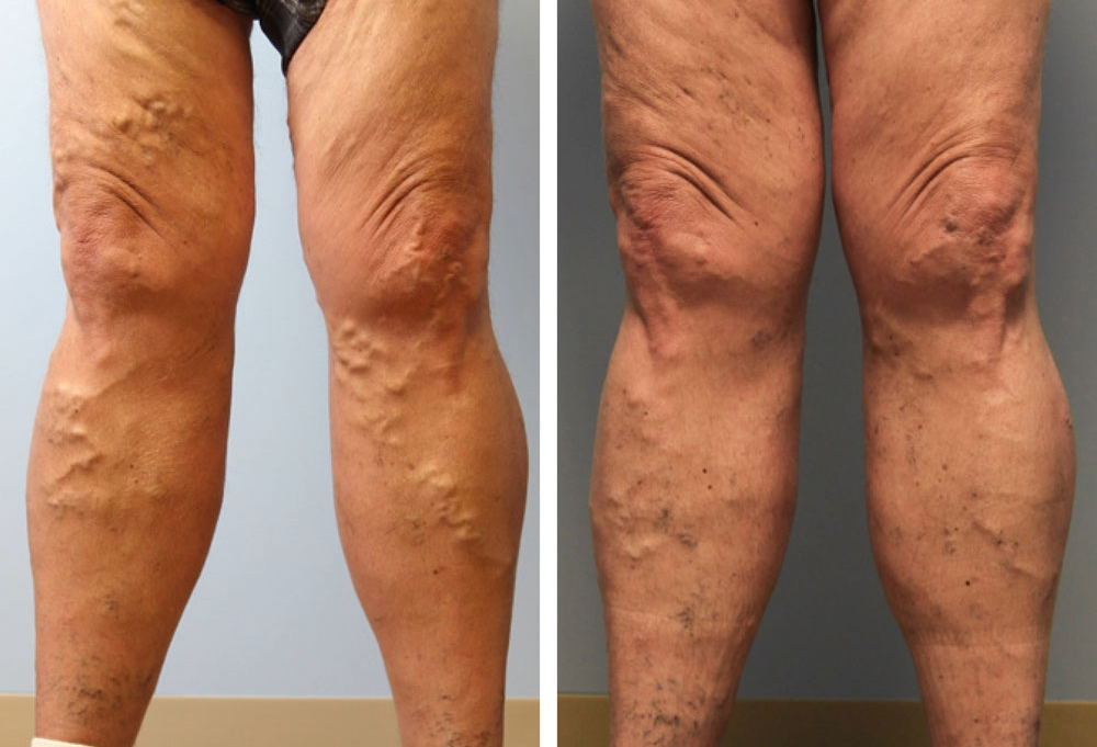 Patient before and after spider vein treatment with visible reduction in vein appearance