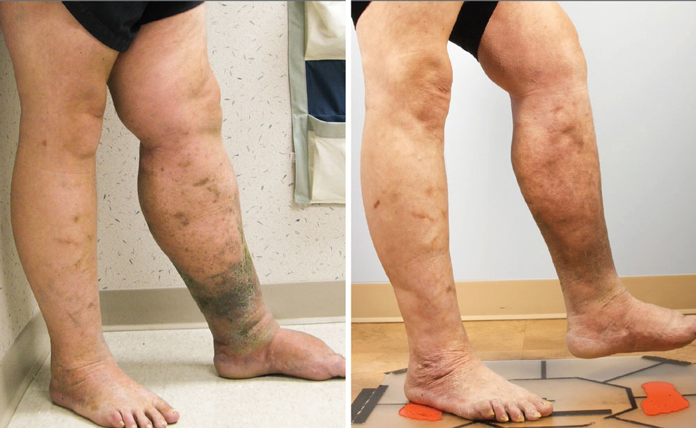 Patient before and after leg vein treatment demonstrating dramatic improvement in vein health